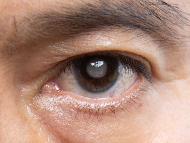 brilliant-vision-glaucoma